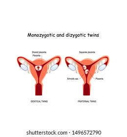 Twins in uterus. Monozygotic and Dizygotic. fraternal  and identical twins. separate and shared placenta