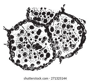 Two alveoli and a part of third from lung in catarrhal pneumonia, vintage engraved illustration. 