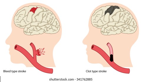 Two Causes Of Stroke, A Bleed Type Stroke And A Clot Type Stroke.