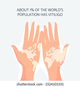 Two fair skin hands with vitiligo depigmentation in a shape of world map. World vitiligo day concept. Vector. 