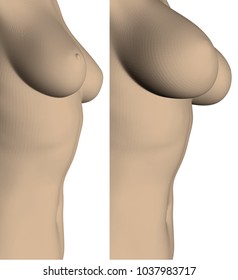 Two female breasts before and after surgery. Increase of the female breast. 3D. Vector illustration. Large size of the female breast.