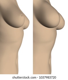 Two female breasts before and after surgery. Increase of the female breast. 3D. Vector illustration. Large size of the female breast.