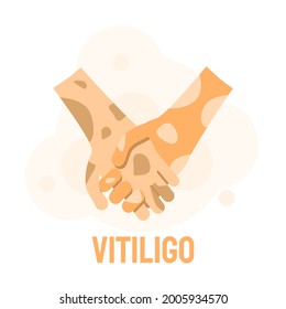 Two Hands Are Holding Each Other With Vitiligo Depigmentation Disease Vector Design Style Concept People Are Equal