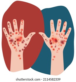 Two hands raised up. Manifestation of skin disease signs in people with white skin tone. Rash on both human hands. Irritation, rash, dermatitis. Design for medicine or dermatology, medical sites, app.