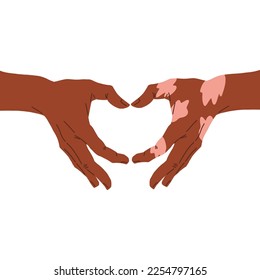 Two hands showing heart shape, one hand with vitiligo patch