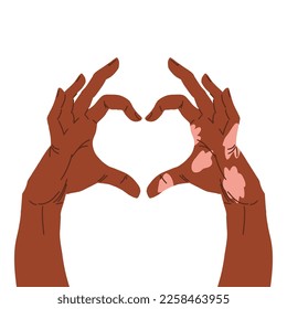 Two hands showing heart shape, one hand with vitiligo patch