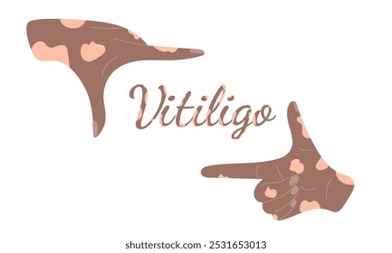 Two hands with vitiligo disease made a frame for text on white background. World vitiligo day awareness. Hand drawn vector illustration in flat style. Skin disease, diversity concept.