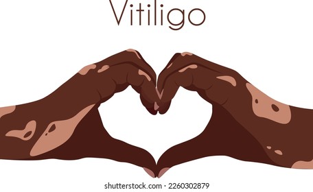 Two hands with vitiligo patches in the shape of a heart. Self love concept. World Vitiligo Day. I love my skin. Brown skin with a patch of vitiligo. Skin diseases. Self care 