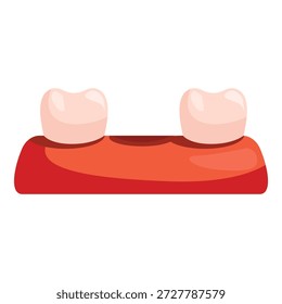 Dois dentes saudáveis ligados às gengivas representando um implante dentário
