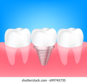 Two healthy teeth and implant tooth between. Human tooth implant concept. Illustration on blue background.