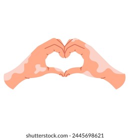 Two light-skinned hands with depigmentation from vitiligo, depicting a heart-shaped gesture, isolated on a white background. Self-love, body positive. Vector illustration in a flat style