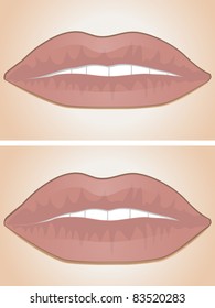 Two sets of lips shown before and after lip filler injections