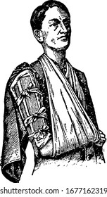 Two splints applied, one in front, the other behind, if the lower part of the bone is broke; or to the inner and outer sides, vintage line drawing or engraving illustration.
