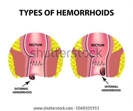 Two types of hemorrhoids are external and internal. Rectum structure. Intestines. colon. Internal and external hemorrhoidal node. Infographics. Vector illustration on isolated background