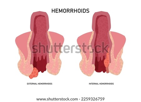 Two types of hemorrhoids. Internal and external hemorrhoidal node, swollen veins in your lower rectum. Flat vector illustration.