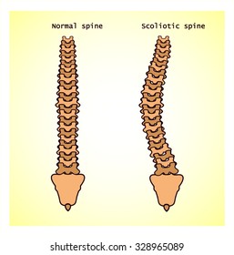 Two types of spine - normal and twisted . The scoliosis. Vector illustration