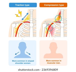 Two types of thoracic outlet syndrome, traction and compression - Shutterstock ID 2369396809