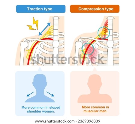 Two types of thoracic outlet syndrome, traction and compression