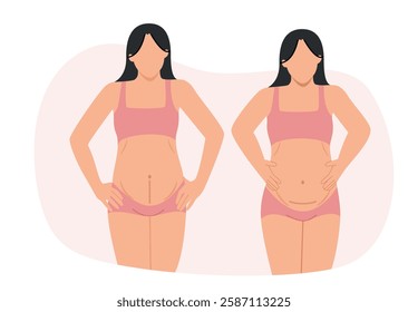 Two women with cesarean section wounds that are horizontal along the waistband of their panties and vertical below their navel.