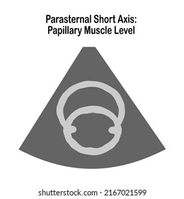 The Two-Dimensional Echocardiographic Examination.  Echocardiographic view: Parasternal short axis view : Papillary muscle level