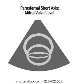 The Two-Dimensional Echocardiographic Examination.  Echocardiographic view: Parasternal short axis view : Mitral valve level