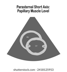 Die zweidimensionale Echokardiographische Untersuchung.  Echokardiographische Sicht: Kurzachsansicht des Parasterns: Papillarmuskulatur