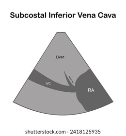 The Two-Dimensional Echocardiographic Examination.  Echocardiographic view: Subcostal Inferior Vena Cava