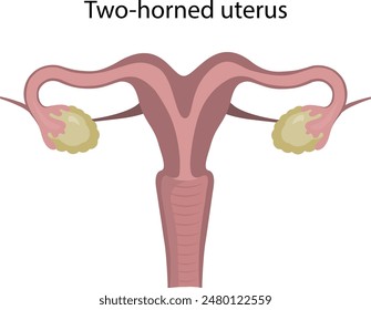 Two-horned uterus. Malformations of the uterus.