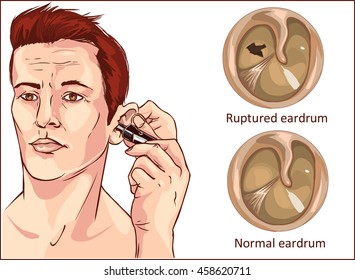 Tympanic Membrane