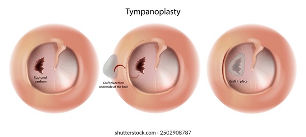 Tympanoplasty Surgery Operation. Reconstruct hearing mechanism of middle ear. Ruptured eardrum