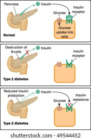 Type 1 and type 2 diabetes