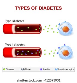 Type 1 And Type 2 Diabetes Mellitus. Insulin Resistance And Insufficient Insulin Production.