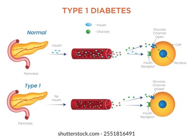 Un diagrama de la diabetes tipo 1 ilustra la afección autoinmunitaria, sus causas, la dependencia de la insulina, los síntomas y el manejo para una mejor comprensión.