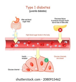 Type 1 diabetes. juvenile diabetes. High blood sugar levels in the body. Glucose channels in the cells are closed. Vector poster for educational and medical use