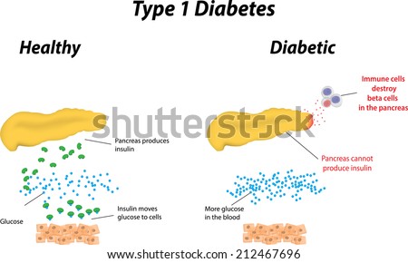 Type 1 Diabetes Labeled Diagram