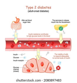 Type 2 diabetes. adult-onset diabetes. Insulin resistance contributes to high glucose levels in the blood. The inability of cells to respond adequately to normal levels of insulin. Vector poster