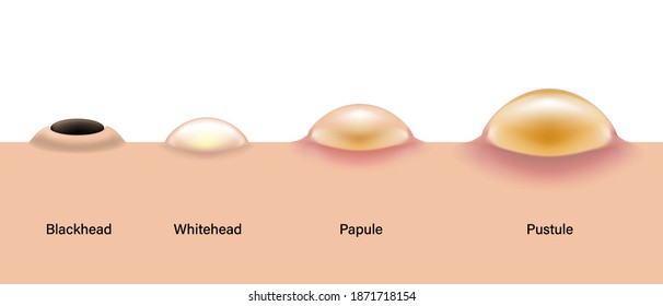 Type of acne diagram, Skin acne on side view, Blackhead, Whitehead, Papule, Pustule, Skin problems