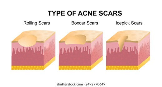 Type Acne Scars Layer vector isolated on white background. Acne Scars