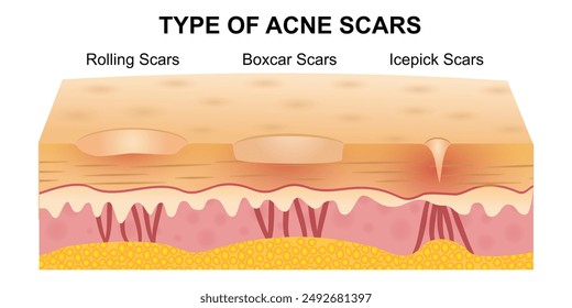 Type of acne scars vector isolated on white background. Acne scars