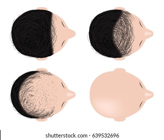 type of baldness , bald head vector . no hair