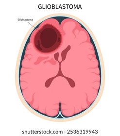 Type of Brain cancer called Glioblastomas the anatomy in medical