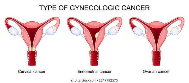 Tipo de cáncer. el diagrama muestra la sección transversal del útero con diferentes partes del sistema reproductivo de la mujer. Tumores malignos. afiche vectorial