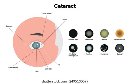Type cataracts and human eye diagram 