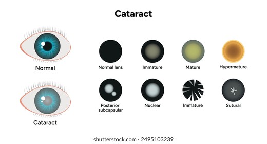 Type cataracts vision disorder problem and normal eye vision