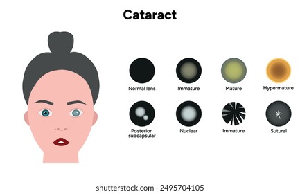 Type cataracts vision disorder problem and vision human eye with cataract eye	