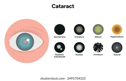 Type cataracts vision disorder problem and vision human eye with cataract eye zoom