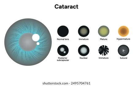 Type cataracts vision disorder problem and vision human cataract eye 