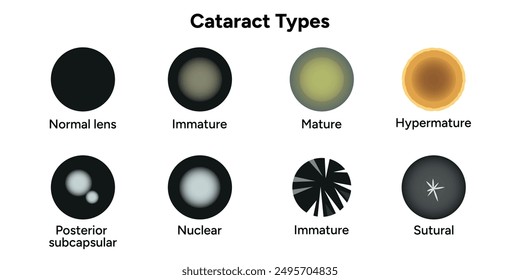 Type cataracts vision disorder problem 