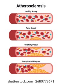 Tipo de colesterol em vasos sanguíneos humanos. LDL de lipoproteína de baixa densidade. HDL de lipoproteína de alta densidade. Artéria normal, vasculares bloqueadas, manchas gordurosas, placa, moderada. Ilustração do vetor médico.