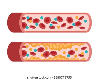 Tipo de colesterol em vasos sanguíneos humanos. LDL de lipoproteína de baixa densidade. HDL de lipoproteína de alta densidade. Artéria normal, vasculares bloqueadas, manchas gordurosas, placa, moderada. Ilustração do vetor médico